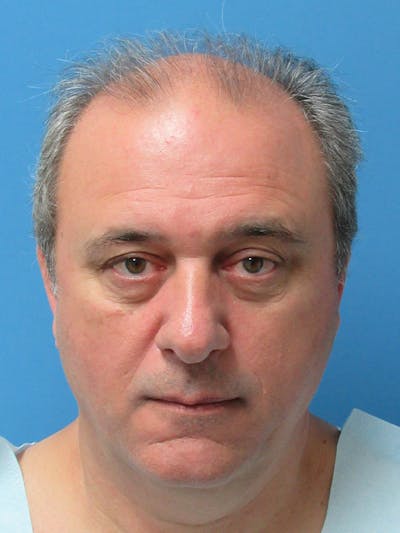 Male Hair Transplant Before & After Gallery - Patient 229621 - Image 1
