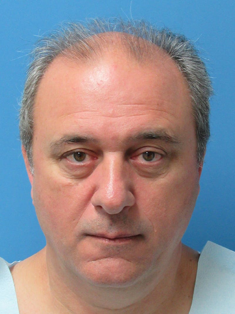 Male Hair Transplant Before & After Gallery - Patient 229621 - Image 1