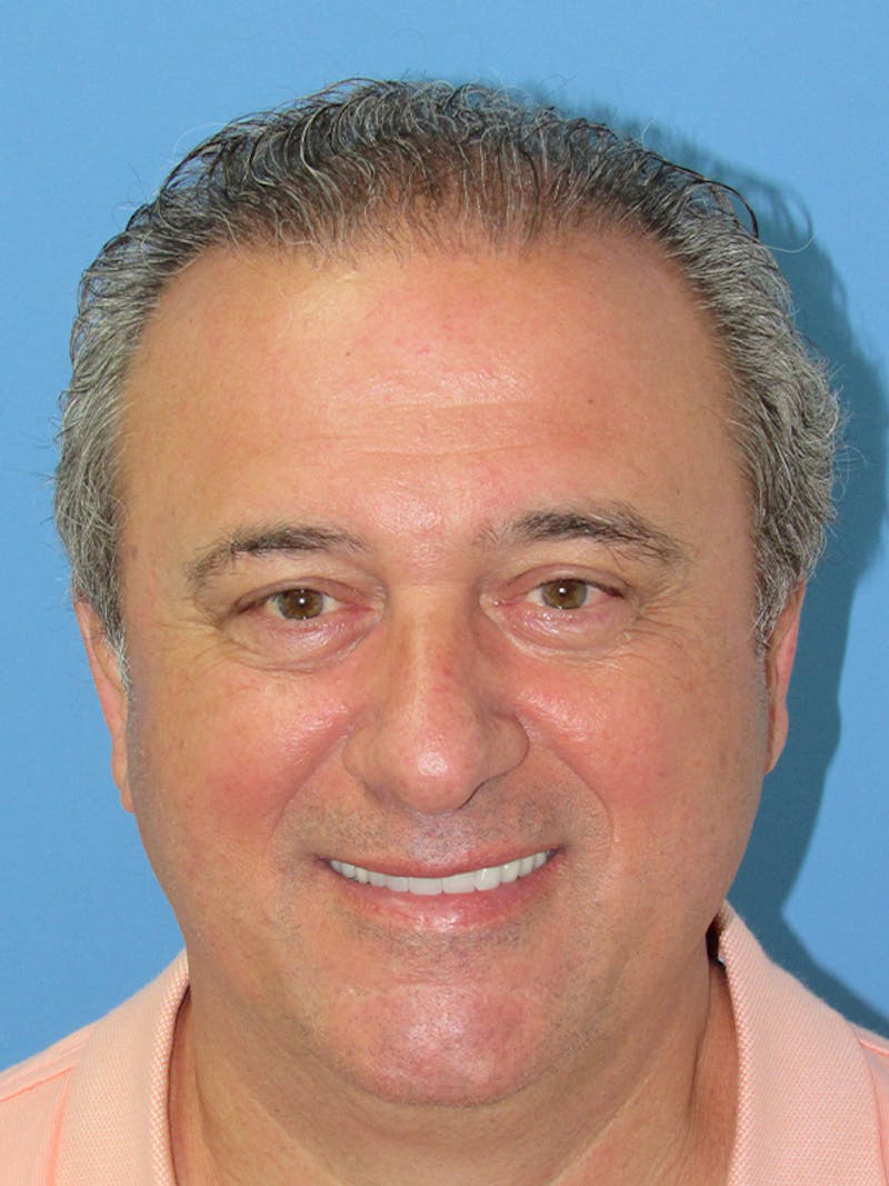 Male Hair Transplant Before & After Gallery - Patient 229621 - Image 2