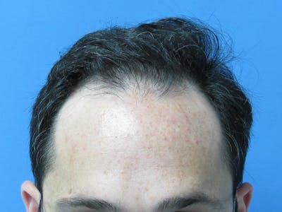 Male Hair Transplant Before & After Gallery - Patient 392846 - Image 1