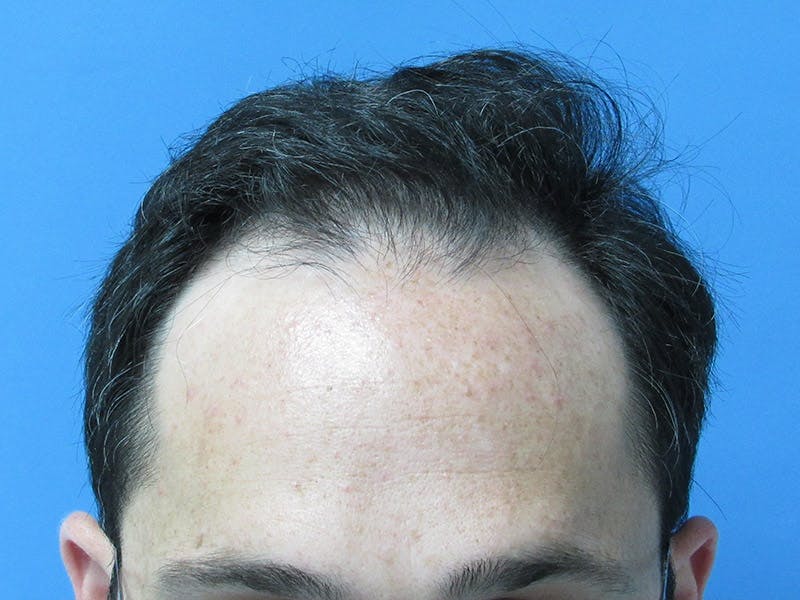 Male Hair Transplant Before & After Gallery - Patient 392846 - Image 1