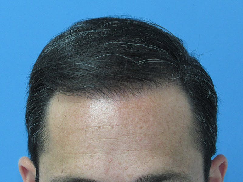 Male Hair Transplant Before & After Gallery - Patient 392846 - Image 2