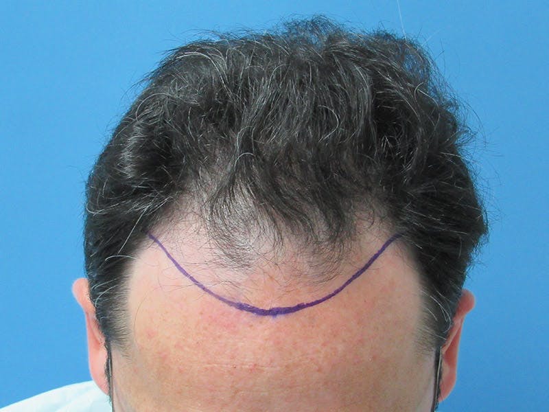 Male Hair Transplant Before & After Gallery - Patient 392846 - Image 3
