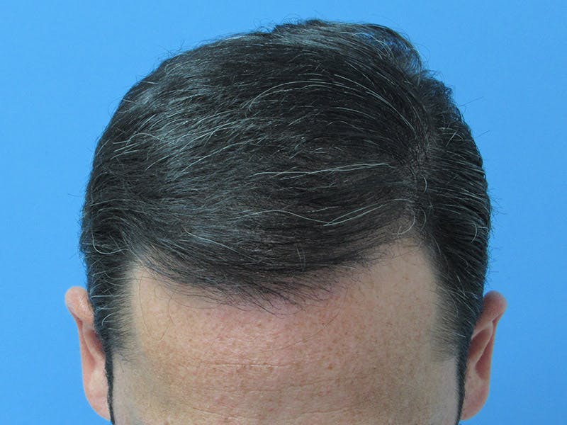 Male Hair Transplant Before & After Gallery - Patient 392846 - Image 4