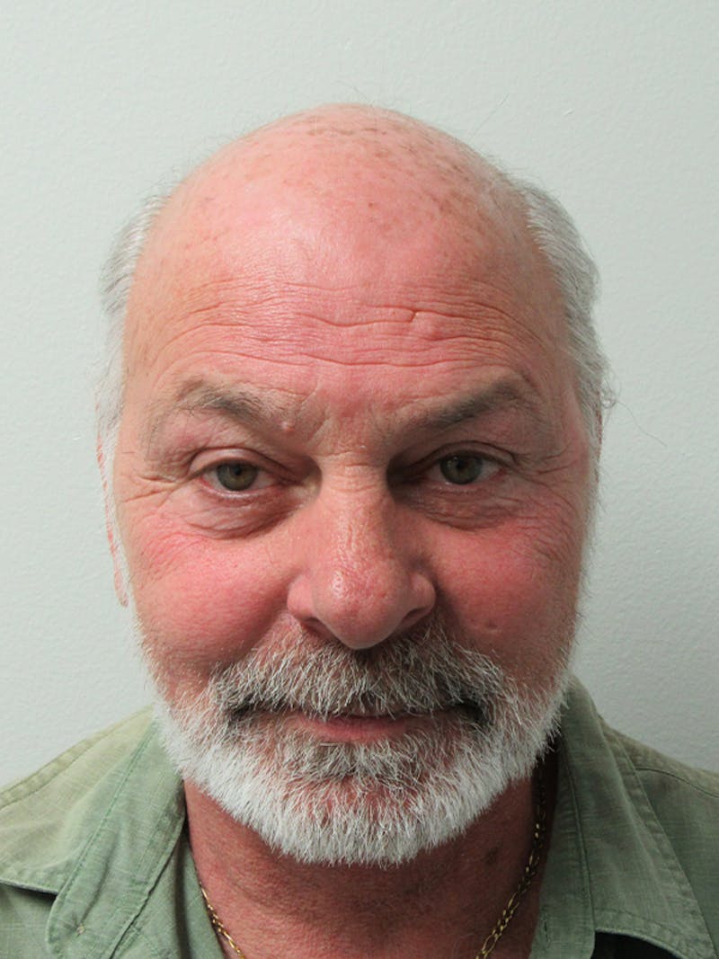 Male Hair Transplant Before & After Gallery - Patient 134511 - Image 1