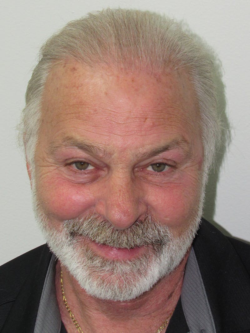Male Hair Transplant Before & After Gallery - Patient 134511 - Image 2