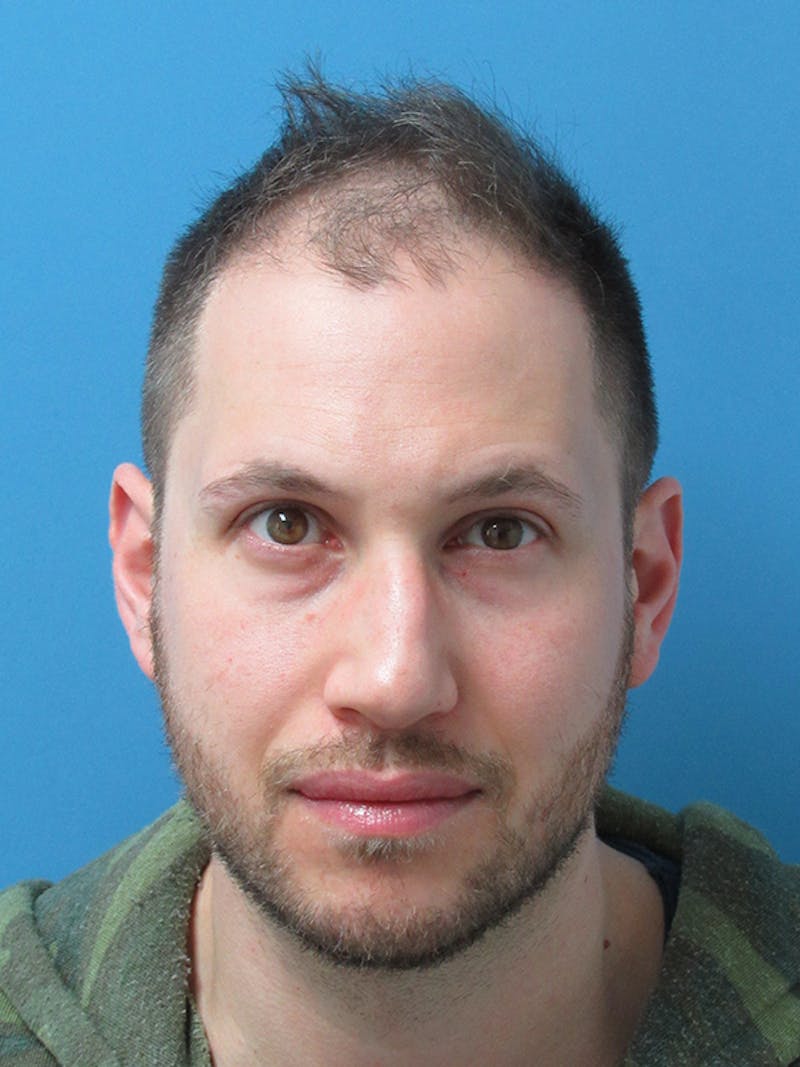 Male Hair Transplant Before & After Gallery - Patient 174217 - Image 1