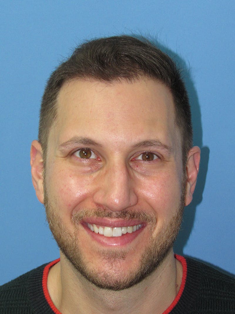 Male Hair Transplant Before & After Gallery - Patient 174217 - Image 2