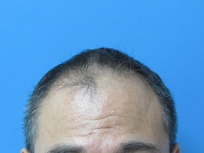 Male Hair Transplant Before & After Gallery - Patient 394495 - Image 1