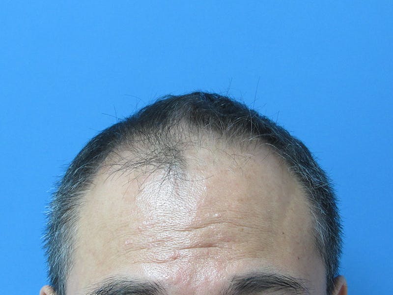Male Hair Transplant Before & After Gallery - Patient 394495 - Image 1