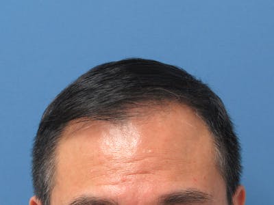 Male Hair Transplant Before & After Gallery - Patient 394495 - Image 2