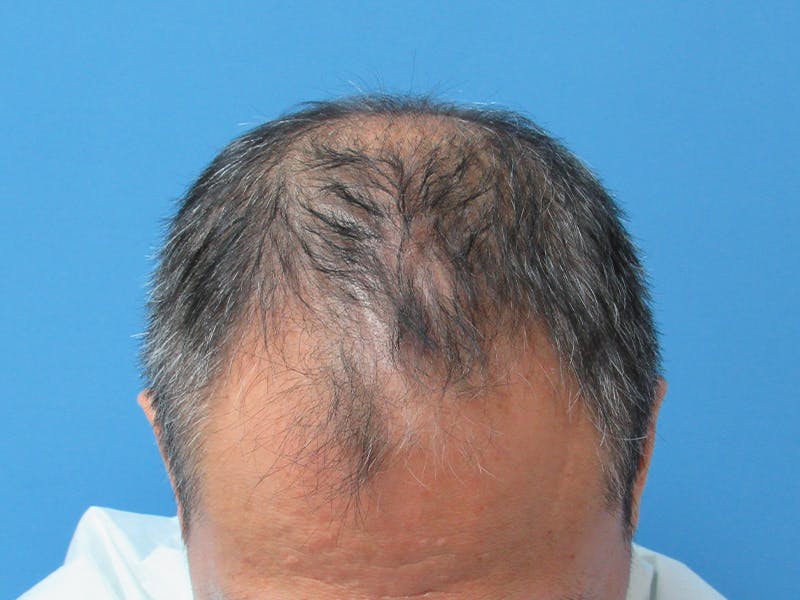 Male Hair Transplant Before & After Gallery - Patient 394495 - Image 3