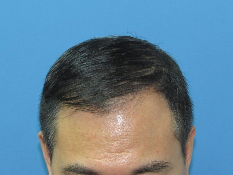 Male Hair Transplant Before & After Gallery - Patient 394495 - Image 4