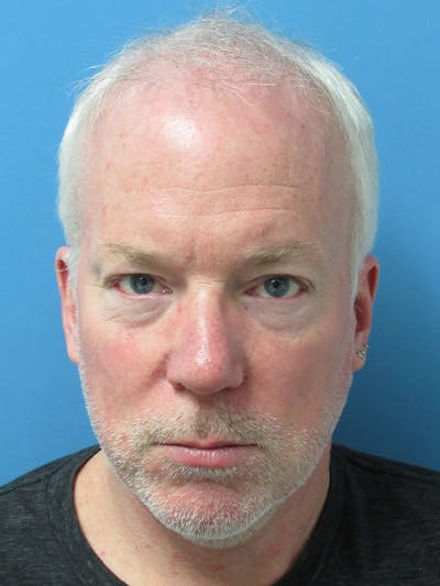 Male Hair Transplant Before & After Gallery - Patient 350076 - Image 1