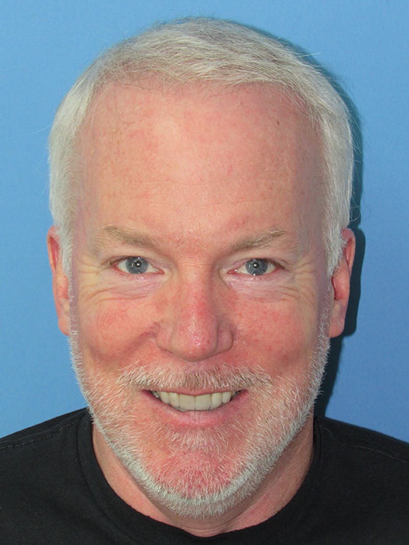 Male Hair Transplant Before & After Gallery - Patient 350076 - Image 2