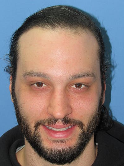 Male Hair Transplant Before & After Gallery - Patient 122123 - Image 2