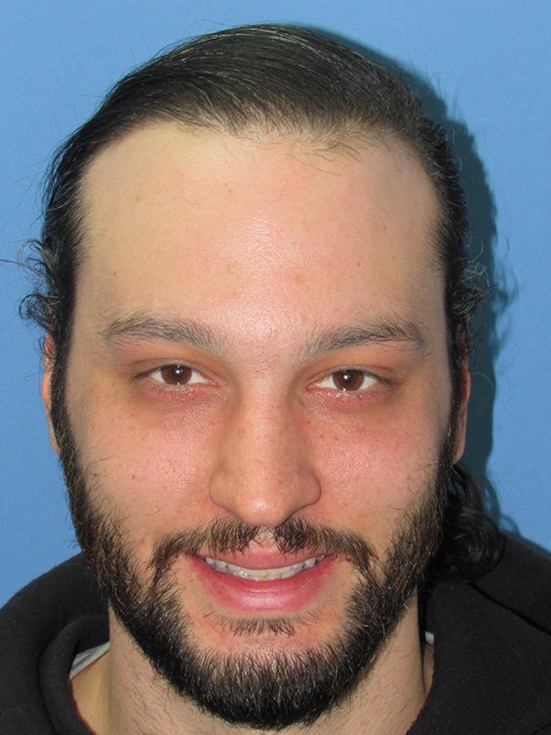 Male Hair Transplant Before & After Gallery - Patient 122123 - Image 2