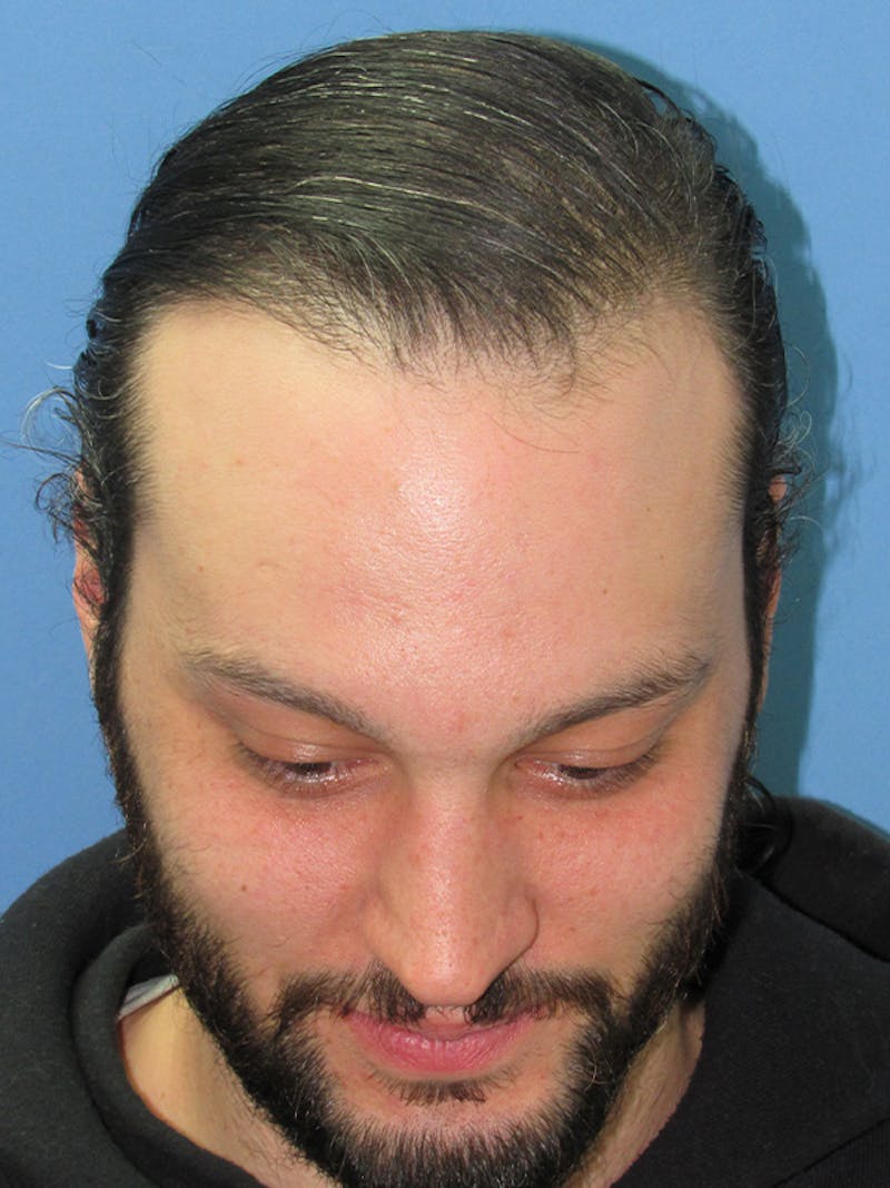 Male Hair Transplant Before & After Gallery - Patient 122123 - Image 4