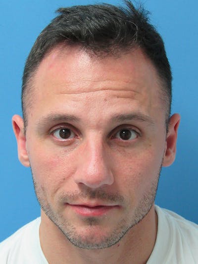 Male Hair Transplant Before & After Gallery - Patient 228156 - Image 1
