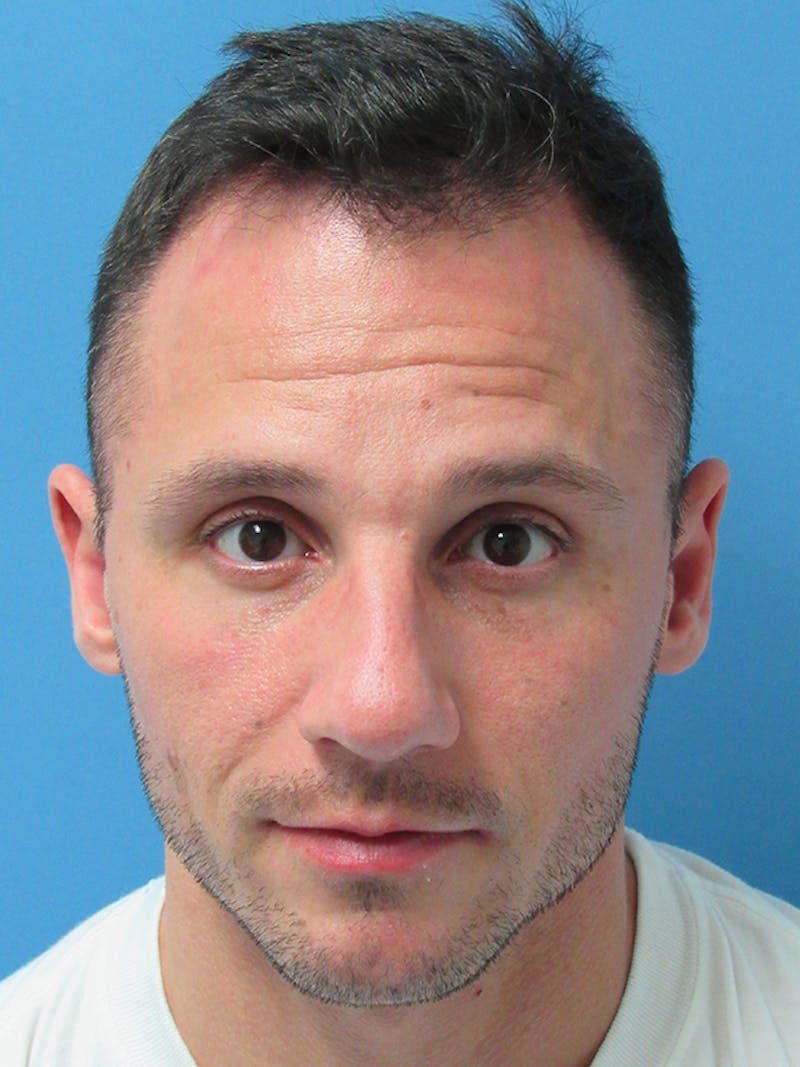 Male Hair Transplant Before & After Gallery - Patient 228156 - Image 1
