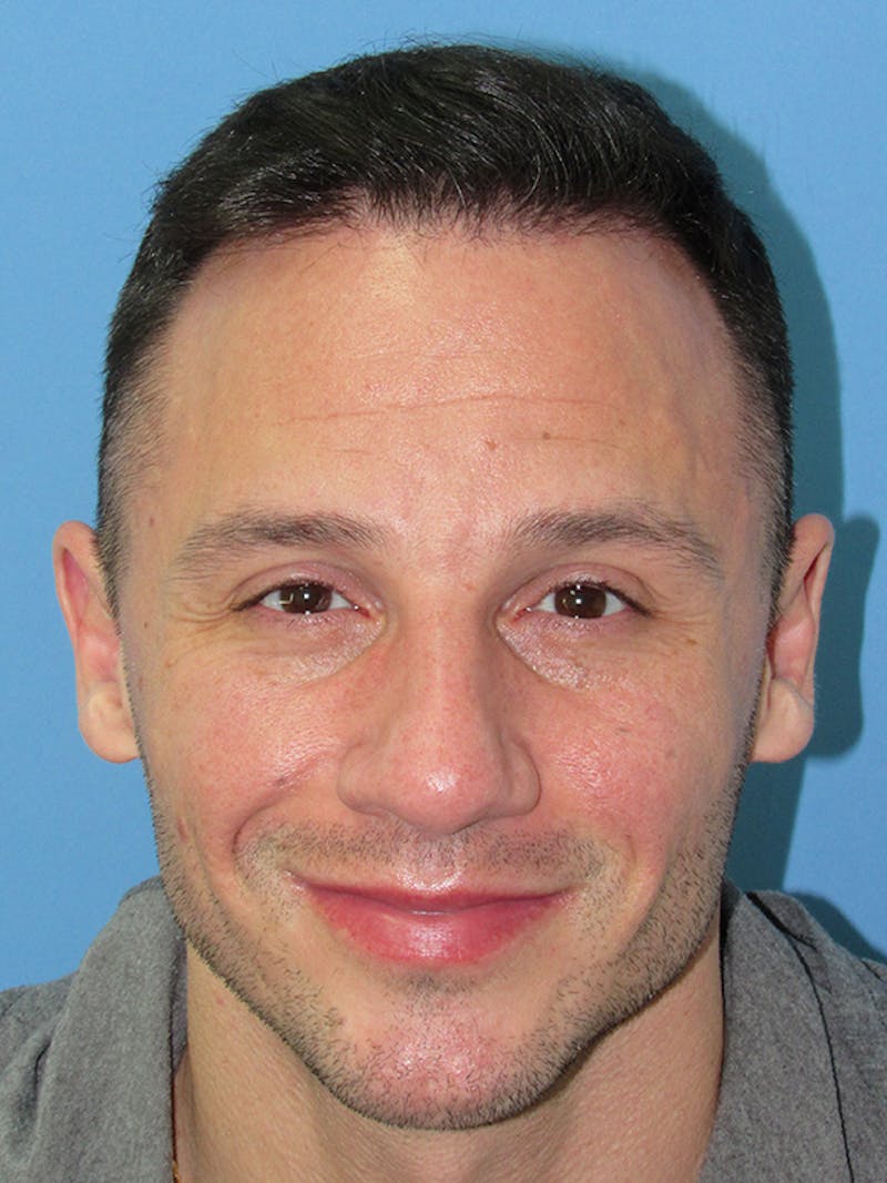 Male Hair Transplant Before & After Gallery - Patient 228156 - Image 2