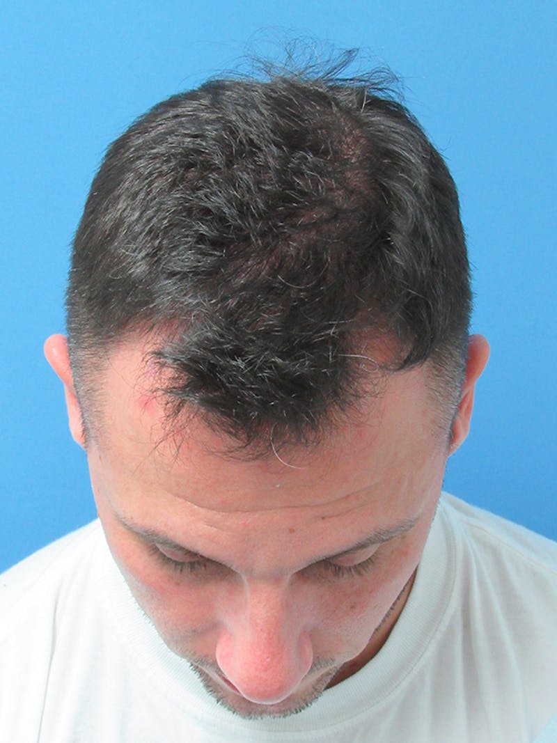 Male Hair Transplant Before & After Gallery - Patient 228156 - Image 3