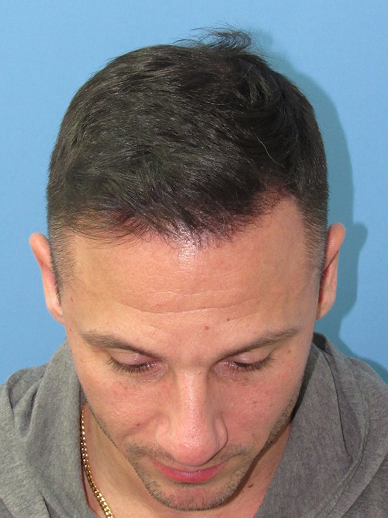 Male Hair Transplant Before & After Gallery - Patient 228156 - Image 4