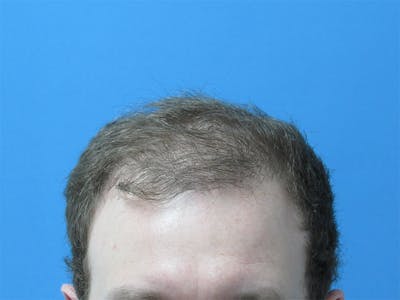 Male Hair Transplant Before & After Gallery - Patient 388284 - Image 1