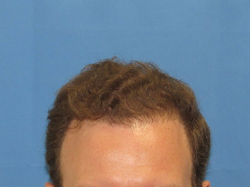 Male Hair Transplant Before & After Gallery - Patient 388284 - Image 2