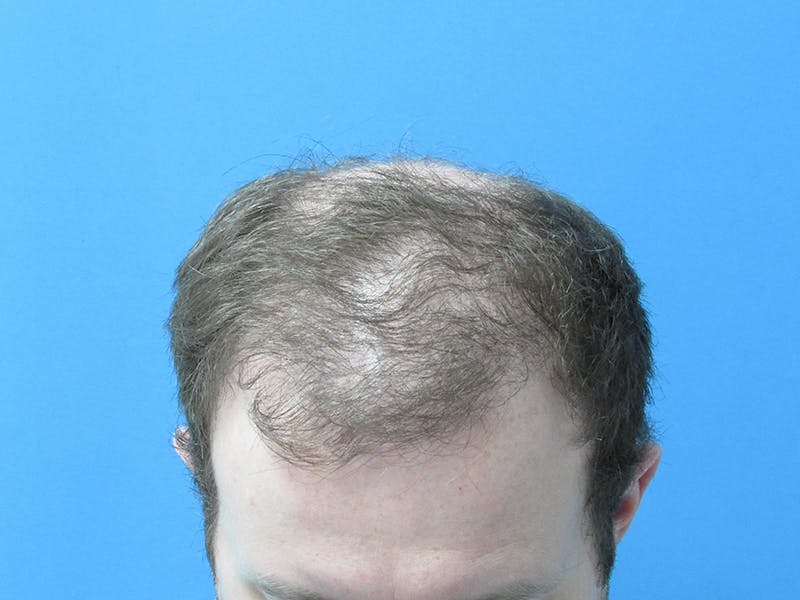Male Hair Transplant Before & After Gallery - Patient 388284 - Image 3