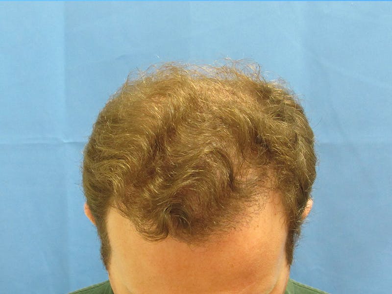 Male Hair Transplant Before & After Gallery - Patient 388284 - Image 4