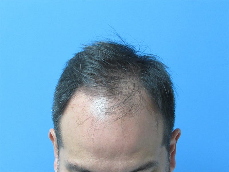 Male Hair Transplant Before & After Gallery - Patient 262356 - Image 1