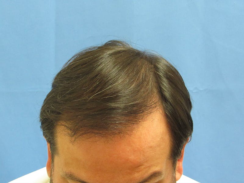 Male Hair Transplant Before & After Gallery - Patient 262356 - Image 2