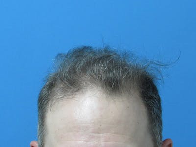 Male Hair Transplant Before & After Gallery - Patient 825867 - Image 1