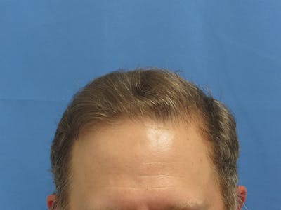 Male Hair Transplant Before & After Gallery - Patient 825867 - Image 2