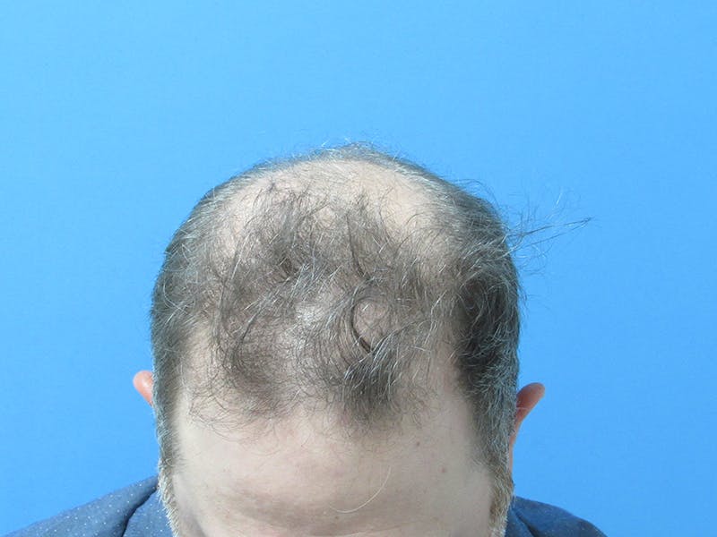 Male Hair Transplant Before & After Gallery - Patient 825867 - Image 3