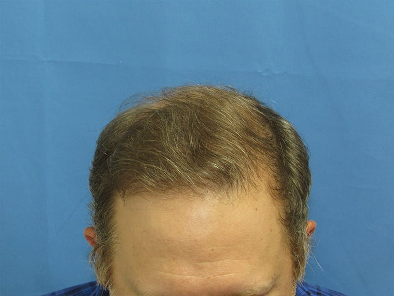 Male Hair Transplant Before & After Gallery - Patient 825867 - Image 4