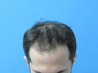 Male Hair Transplant Before & After Gallery - Patient 102035 - Image 1