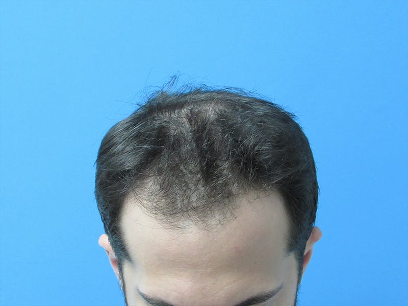 Male Hair Transplant Before & After Gallery - Patient 102035 - Image 1