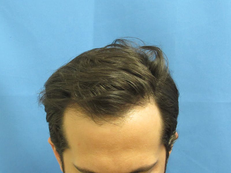 Male Hair Transplant Before & After Gallery - Patient 102035 - Image 2