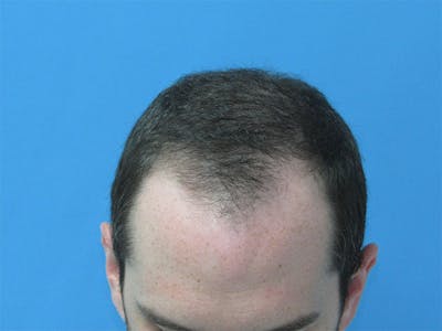 Male Hair Transplant Before & After Gallery - Patient 890004 - Image 1