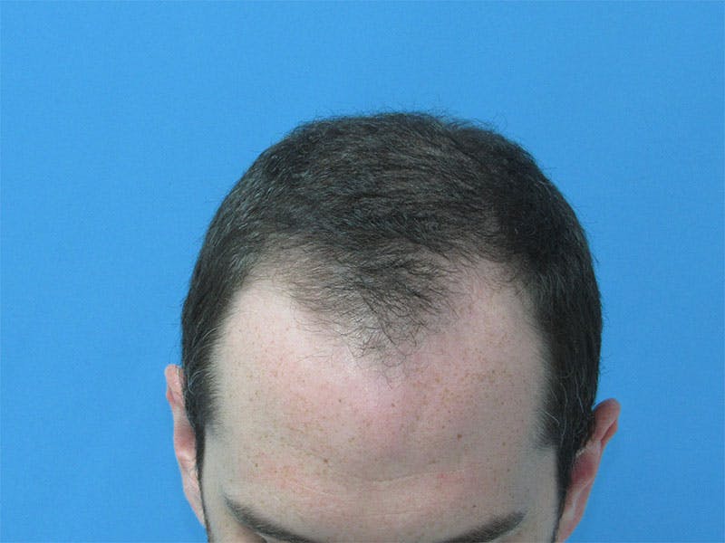 Male Hair Transplant Before & After Gallery - Patient 890004 - Image 1