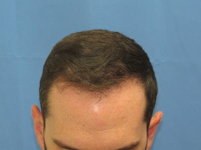 Male Hair Transplant Before & After Gallery - Patient 890004 - Image 2