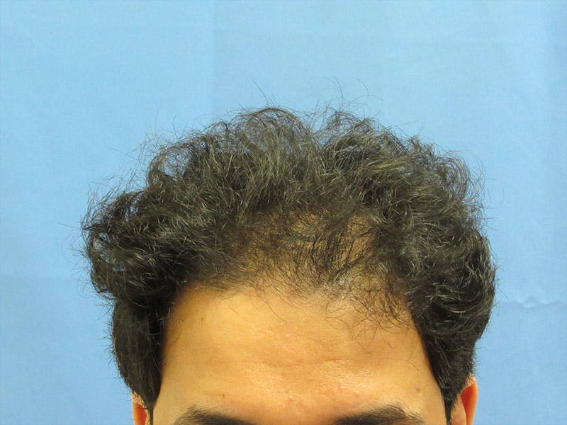 Male Hair Transplant Before & After Gallery - Patient 847306 - Image 1