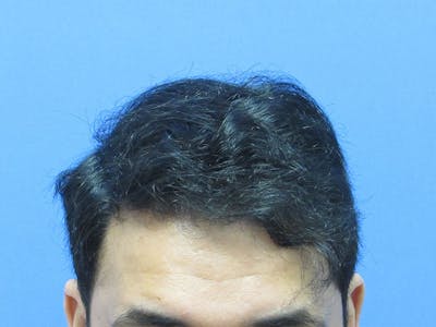 Male Hair Transplant Before & After Gallery - Patient 847306 - Image 2