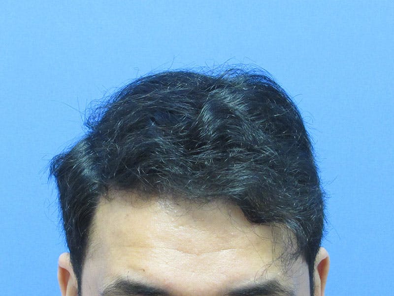 Male Hair Transplant Before & After Gallery - Patient 847306 - Image 2