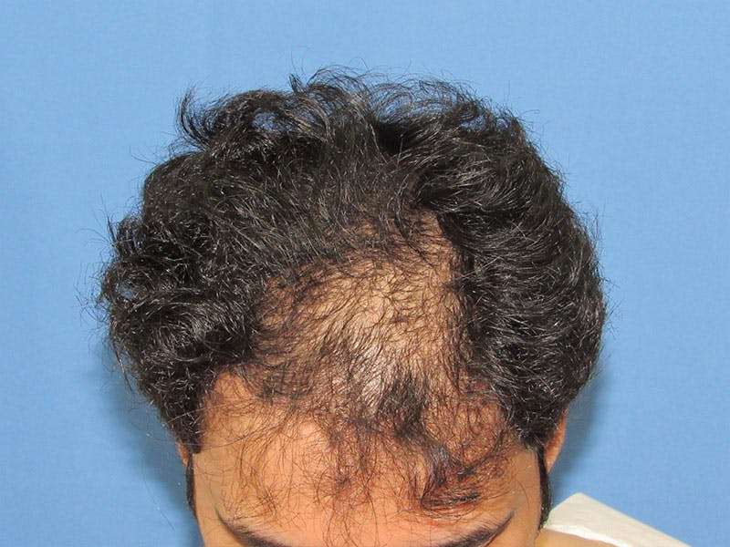 Male Hair Transplant Before & After Gallery - Patient 847306 - Image 3