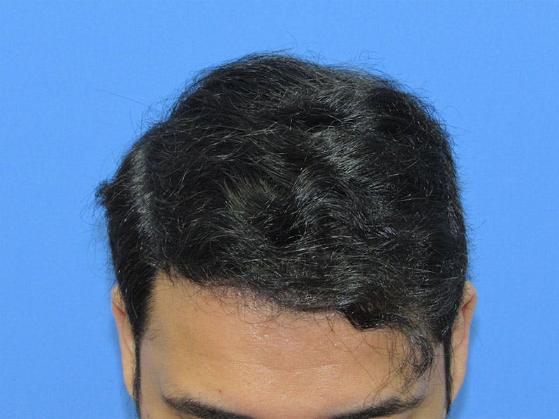 Male Hair Transplant Before & After Gallery - Patient 847306 - Image 4