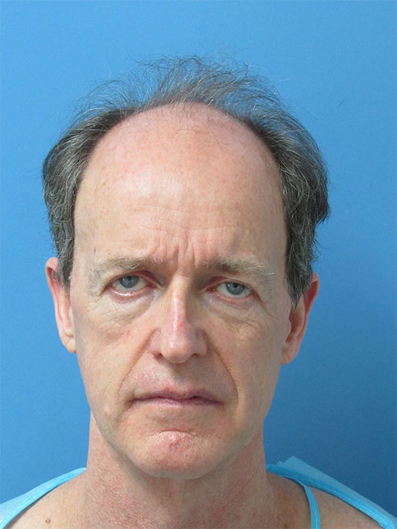 Male Hair Transplant Before & After Gallery - Patient 199381 - Image 1