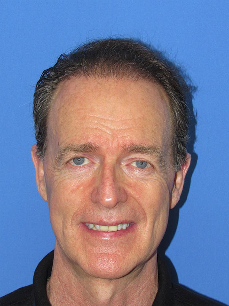 Male Hair Transplant Before & After Gallery - Patient 199381 - Image 2